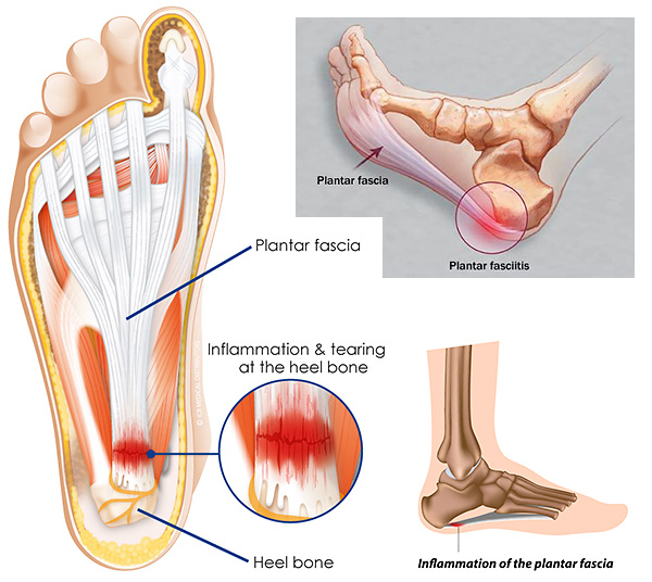 fascia plantitis treatment