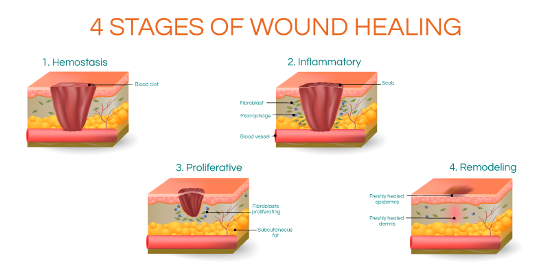 Stages of Wound Healing